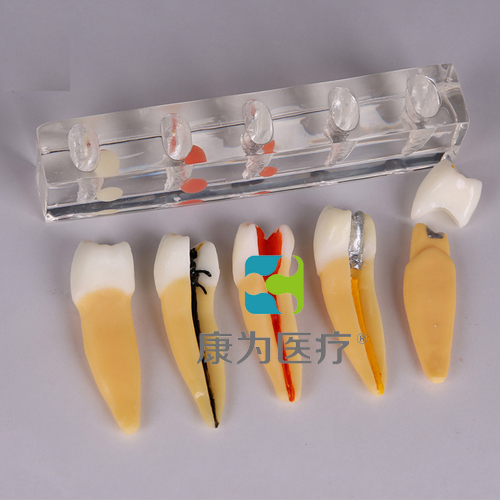 “康为医疗”牙髓病治疗模型